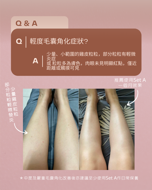 毛囊角化封殺組SET A ― 適合輕度毛囊角化