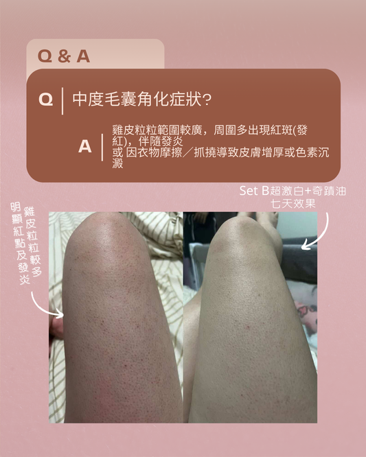 毛囊角化封殺組SET B ― 適合中度毛囊角化