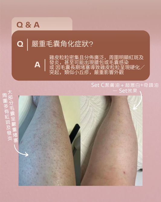 毛囊角化封殺組SET C ― 適合嚴重毛囊角化